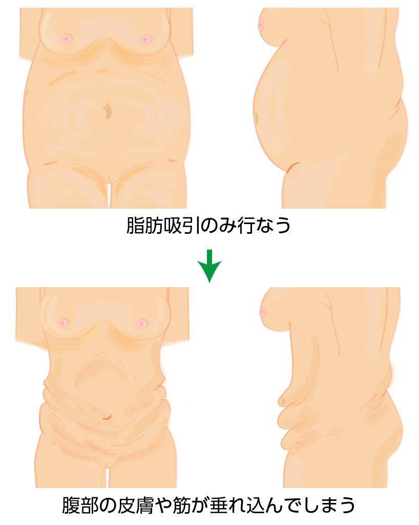 脂肪吸引のみでは、腹部の皮膚や筋が垂れ込んでしまう例