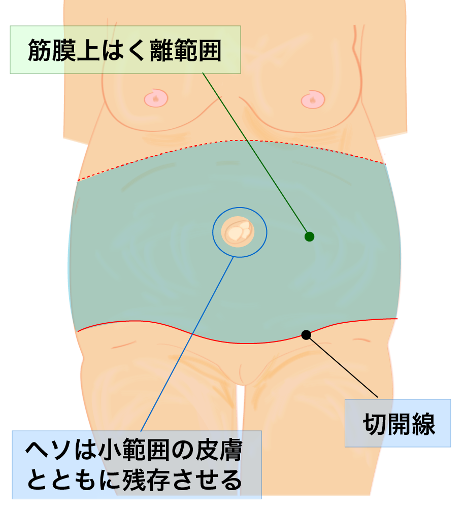 腹部リダクションのデザイン
