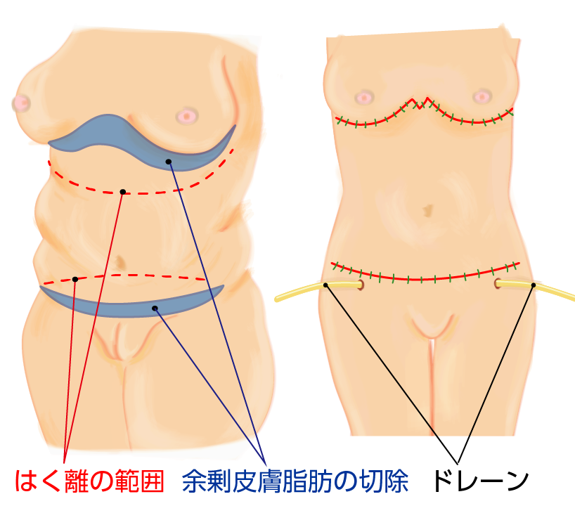 腹部脂肪切除(タミータック)の手術の下腹部と上腹部の同時切開の模式図