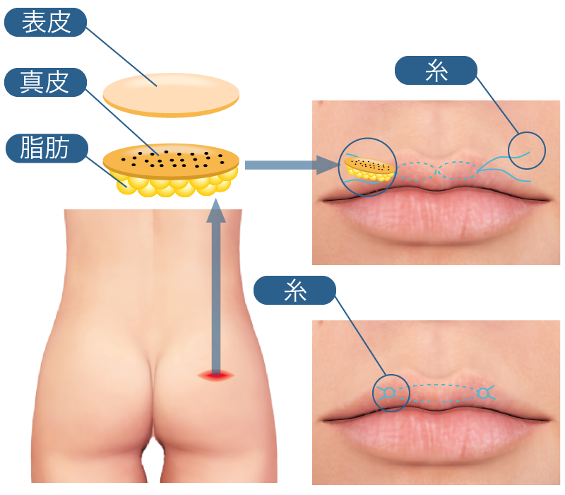 真皮脂肪移植(ダーマルファット)の模式図