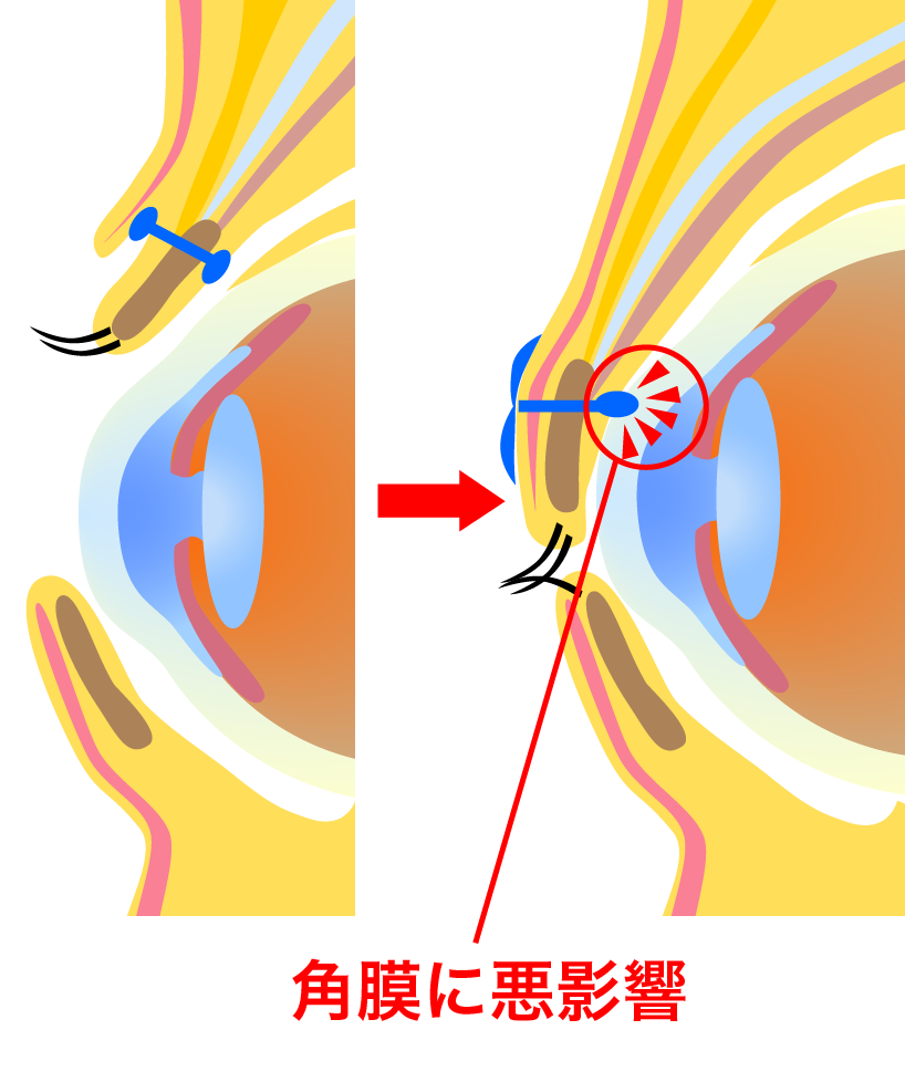 瞼板法の場合、二重まぶたの埋没糸を通すところがあまり真ん中だと瞼を閉じた時に、眼球の角膜に悪影響を及ぼすことがあります