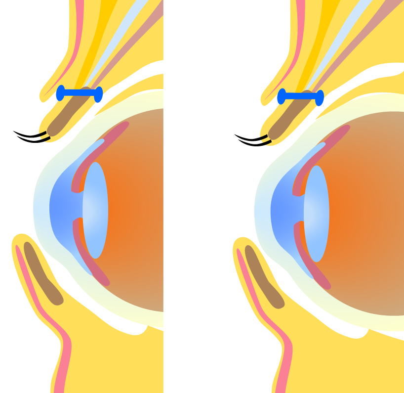 瞼板の上端で挙筋腱膜の付着部に二重まぶた埋没糸を通す