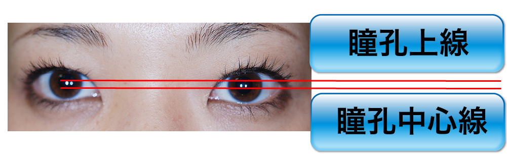 眼瞼下垂の診断 目線3