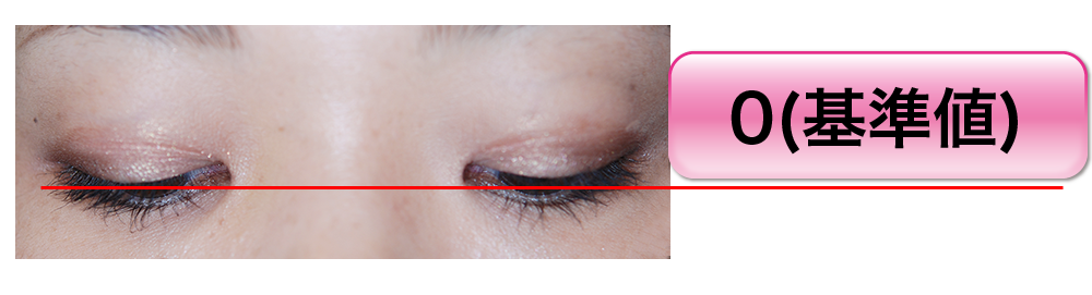 眼瞼下垂の診断 目線1