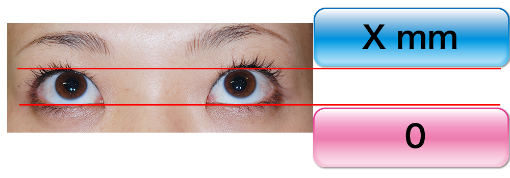 眼瞼下垂の診断 目線2