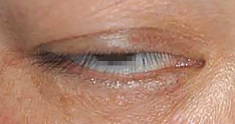眼瞼下垂手術(挙筋腱膜短縮術)の術前症例