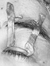 眼瞼下垂 筋膜移植術症例