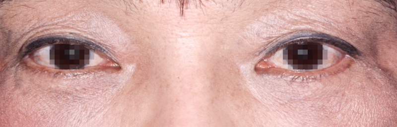 下眼瞼(下まぶた)のしわ・弛み・ふくらみ取り 術直1年目 症例