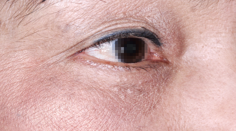 下眼瞼(下まぶた)のしわ・弛み・ふくらみ取り 術後1年目 右目 症例