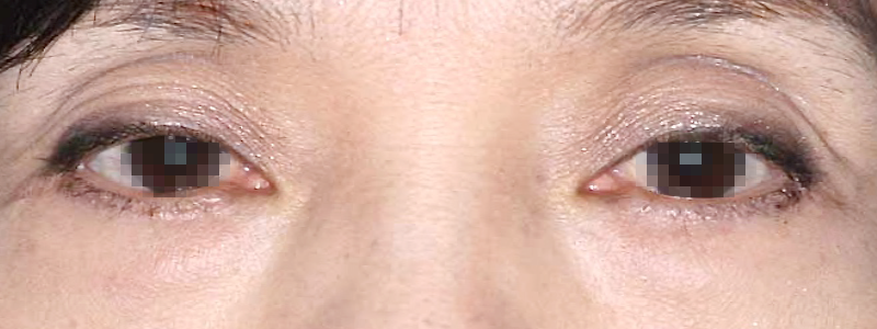 目袋の膨らみ(ティアトロフ)の矯正の術後 症例