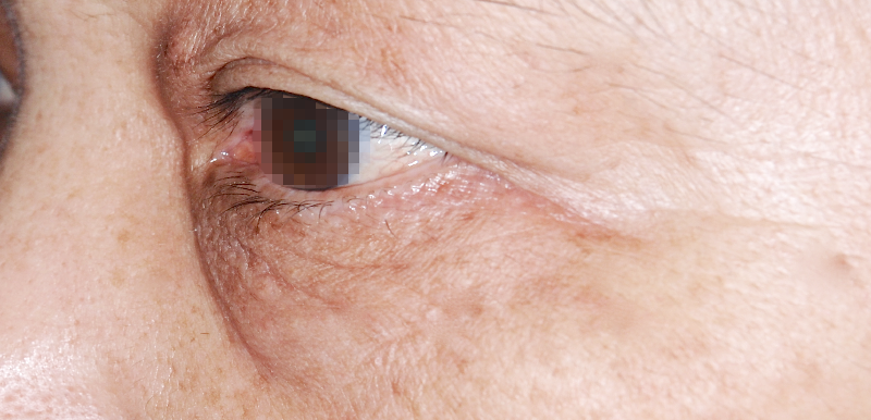 下眼瞼(下まぶた)のしわ・弛み・ふくらみ取り 術前 症例 左目