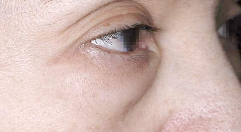 目袋の膨らみ(ティアトロフ)の矯正 術前 症例 右目