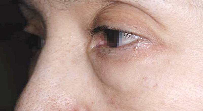目袋の膨らみ(ティアトロフ)の矯正 術前 症例 左目