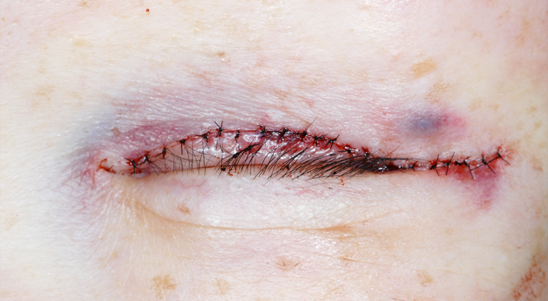 下眼瞼(下まぶた)のしわ・弛み・ふくらみ取りでの皮膚縫合 術直後 閉眼時 症例