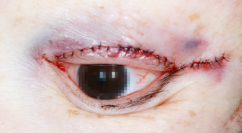 下眼瞼(下まぶた)のしわ・弛み・ふくらみ取りでの皮膚縫合 術直後 開眼時 症例