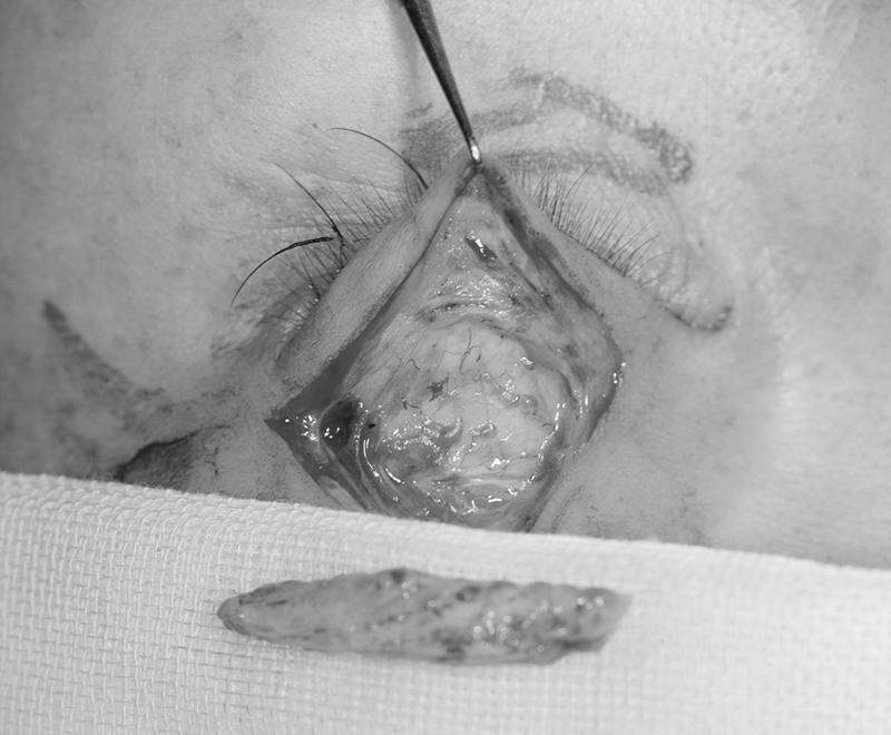 切開式二重まぶた手術の様子、前方は移植する真皮脂肪