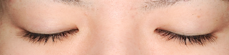 埋没式二重まぶた やや眼瞼皮膚が厚く脂肪量も多い 術後症例 閉眼