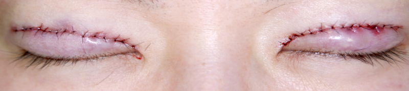 左側が奥二重の重瞼 切開式二重まぶた 術直後 閉眼 症例