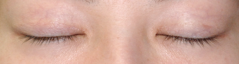 左側が奥二重の重瞼 切開式二重まぶた 術後6ヶ月 閉眼 症例