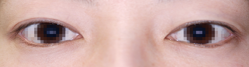 左側が奥二重の重瞼 切開式二重まぶた 術前 開眼 症例