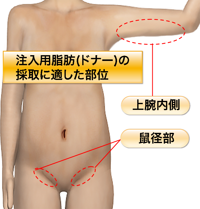 脂肪移植による上まぶたの落ち窪み矯正(サンケンアイズ) 真皮脂肪または、脂肪組織の採取場所