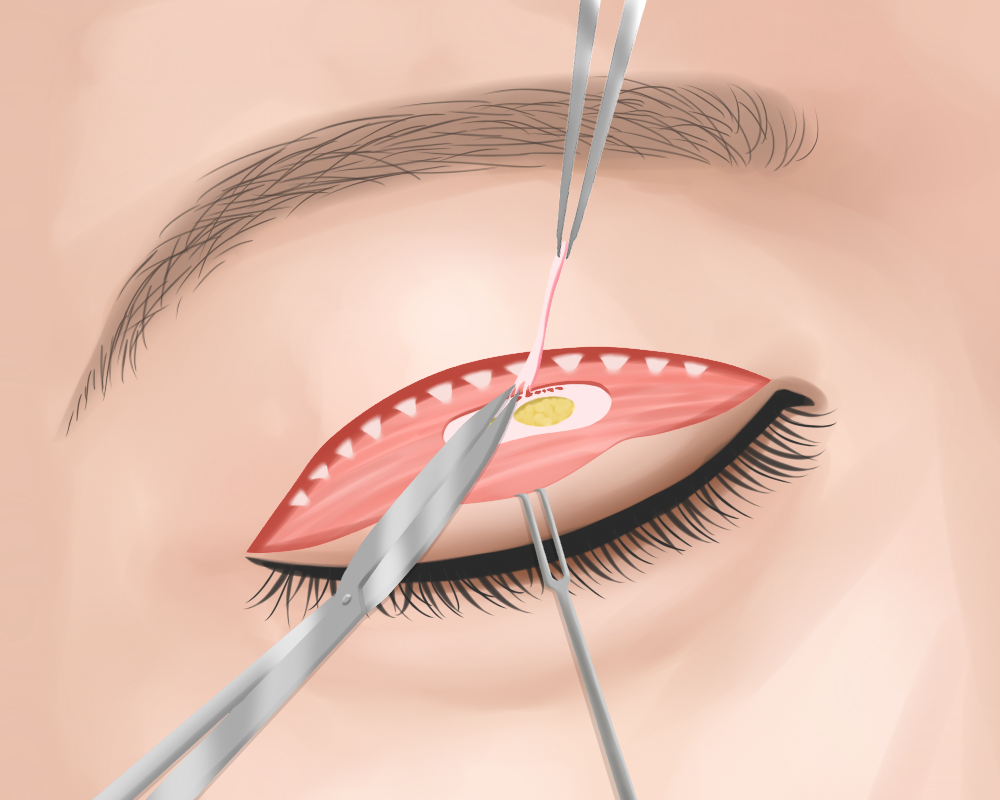 上眼瞼しわ、たるみ取り(切開式二重まぶた) 瞼板前組織、眼輪筋の一部を切除