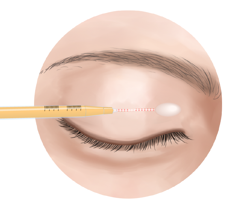 脂肪注入の注射針を眼輪筋の下に進めていきます