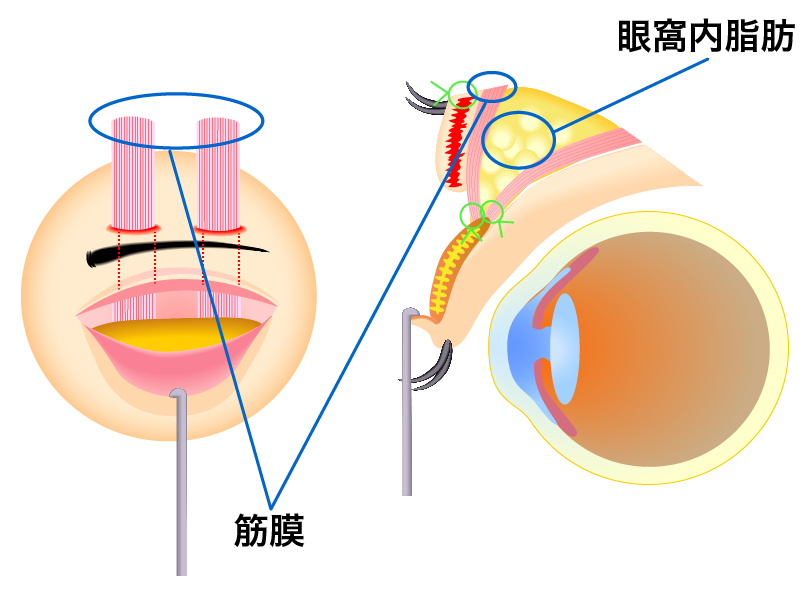 眼瞼下垂 筋膜移植術のしくみ