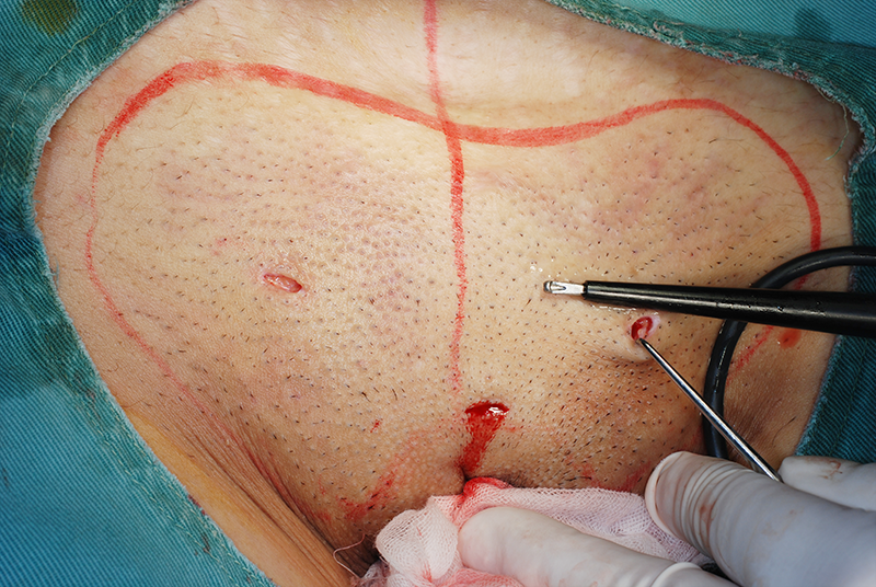 すそわきが手術での超音波メス挿入予定位置4箇所に皮膚切開を行います