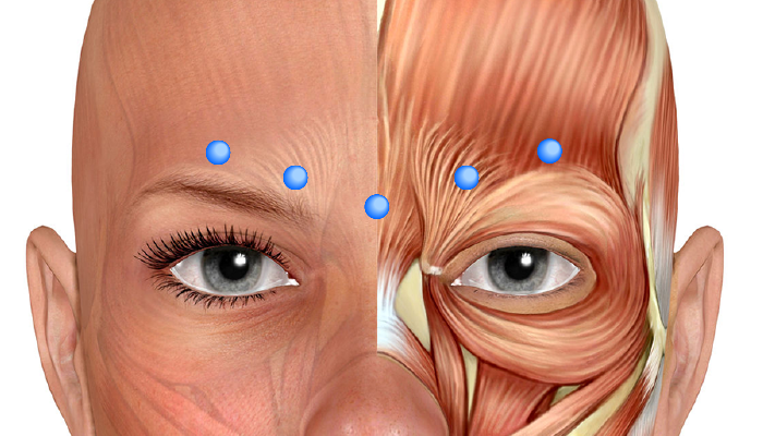 ボトックス（ボツリヌストキシン治療）の眉間のしわへの注入位置例